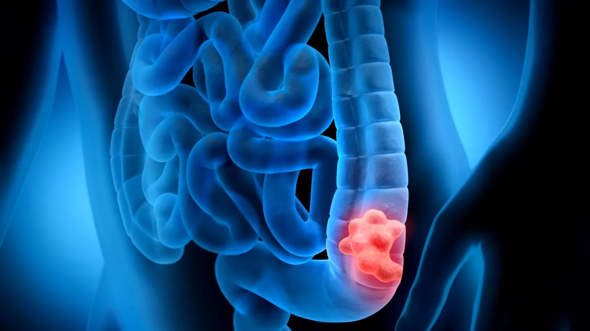 Noi reguli pentru depistarea precoce a cancerului de colon: Ministerul Sănătății propune o nouă metodologie