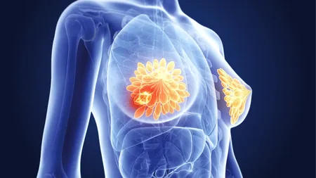 OMS: Estimări alarmante privind diagnosticele și decesele provocate de cancerul de sân