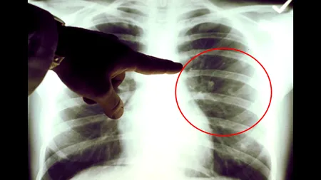 Un test de urină care detectează precoce cancerul pulmonar