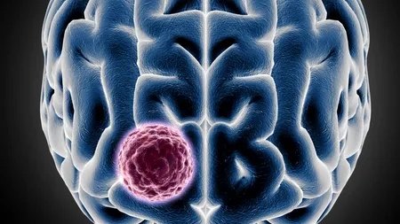 Tumoare cerebrală eliminată cu tratamentul cu celule CAR-T