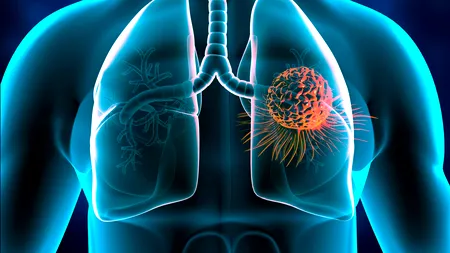 Simptome de pe față care pot indica un cancer pulmonar!