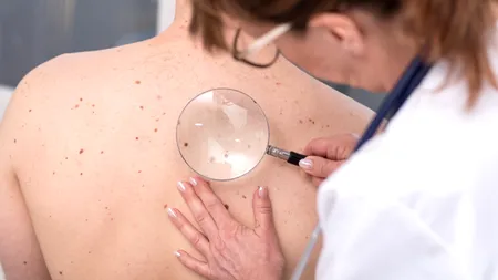 Tehnologia aliată cu IA, pentru detectarea melanomului