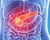 Cancerul pancreatic: două tratamente combinate și un vaccin oferă rezultate uimitoare