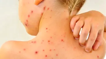 Spania dă vina pe români şi marocani pentru reapariţia cazurilor de rujeolă