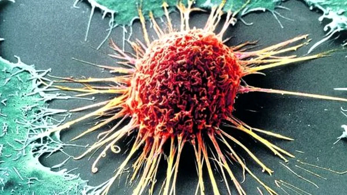 Cancerul colorectal: Un medicament care distruge tumora fără chirurgie și fără chimioterapie