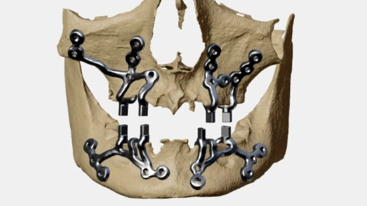 Modelarea 3D, implanturile personalizate și perspectivele lor viitoare în chirurgia craniofacială