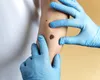 Detectarea cancerului de piele în 30 de secunde