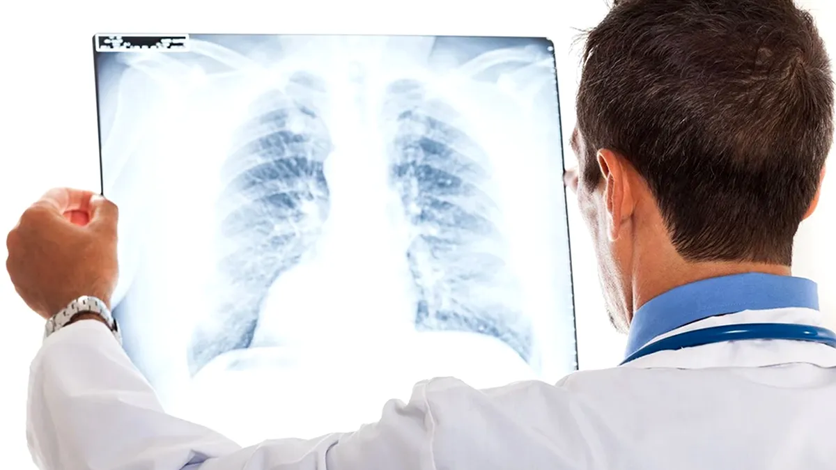Un nou factor de risc al cancerului pulmonar!