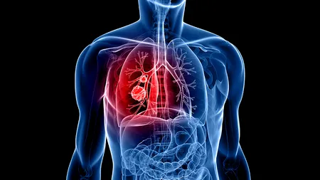 Care este, după fumat, al doilea factor de risc pentru cancerul pulmonar
