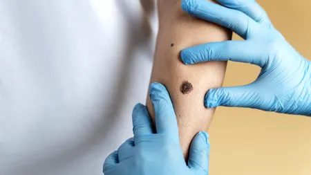 Detectarea cancerului de piele în 30 de secunde