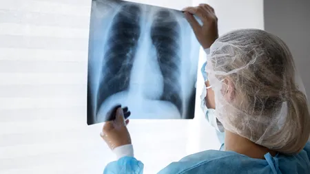 Cancerul pulmonar: Noi terapii prezentate la ASCO 2024 de la Chicago