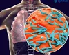 De ce tuberculoza e pe cale să explodeze la nivel global