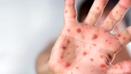 Plasture-vaccin împotriva rujeolei