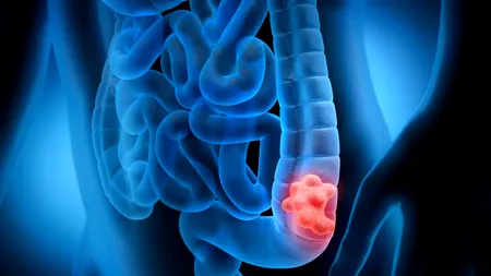 Noi reguli pentru depistarea precoce a cancerului de colon: Ministerul Sănătății propune o nouă metodologie