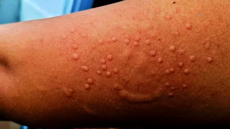 Noua variantă a mpox se transmite predominant de la om la om