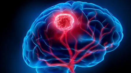 A început testarea unui medicament pentru tumori cerebale