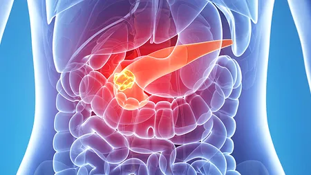 Cancerul pancreatic: două tratamente combinate și un vaccin oferă rezultate uimitoare