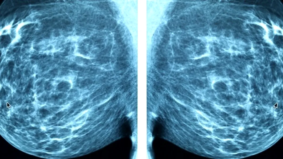 Progres uluitor: IA e capabilă să ”prezică” apariția cancerului la sân!