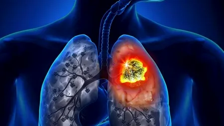 Testul online de evaluare a suspiciunii de cancer pulmonar