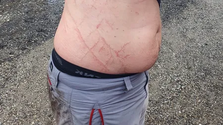 „Tatuajul” făcut de trăsnet pe pielea trupul unui om. Cum să ne ferim de fulgere