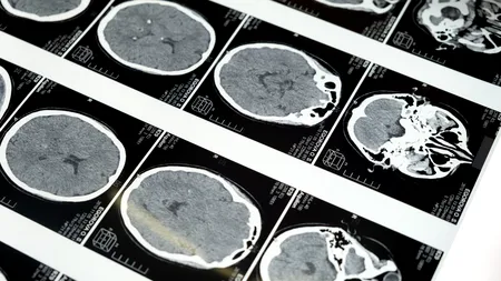 Boală neurologică misterioasă în Canada, după ce mai multe persoane și-au pierdut memoria și au halucinații