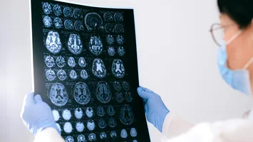 O descoperire de la UMF Craiova deschide noi perspective în tratamentul Alzheimerului