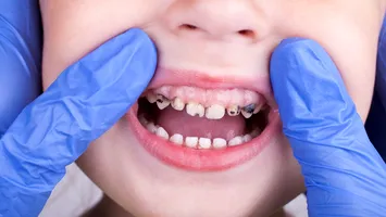 Colegiul Stomatologilor: Două treimi dintre copii au carii netratate!