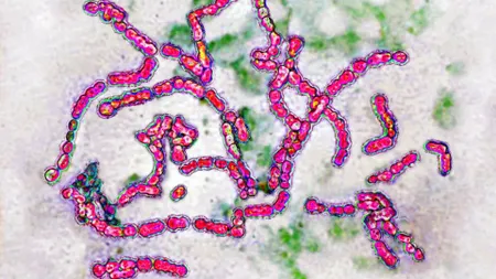 Bacteria carnivoră, care ucide omul în 48 de ore, se răspândește cu viteză