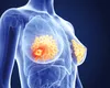 OMS: Estimări alarmante privind diagnosticele și decesele provocate de cancerul de sân