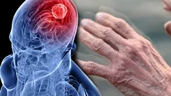 Descoperire revoluţionară. O bacterie a cariilor ar putea accelera boala Parkinson