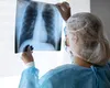 Cancerul pulmonar: Noi terapii prezentate la ASCO 2024 de la Chicago
