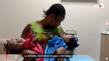 Siameze unite prin stomac la naștere, separate după o intervenție medicală care a durat 17 ore (VIDEO)