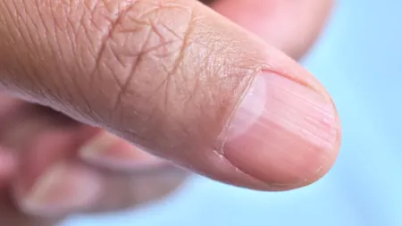 Ce ne ”spun” unghiile cu striații despre  starea de sănătate