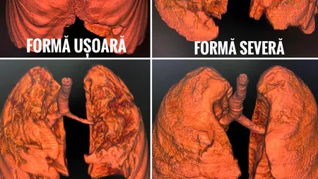 Cum arată plămânii unor pacienți nevaccinați bolnavi de COVID-19