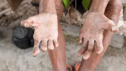 Ministerul Sănătății confirmă primul caz de lepră după 44 de ani. Alte trei persoane, sub monitorizare