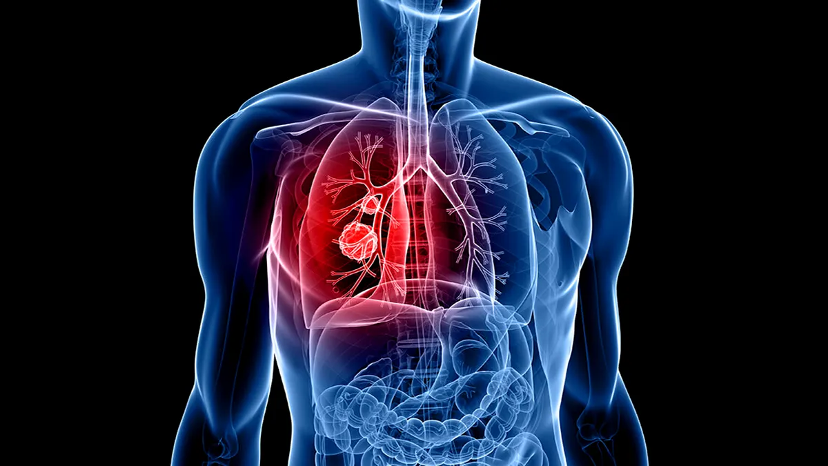 Care este, după fumat, al doilea factor de risc pentru cancerul pulmonar